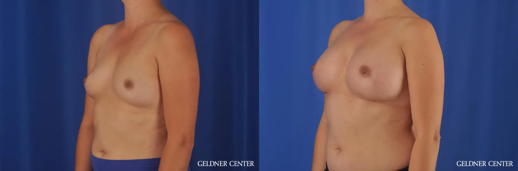 Breast Augmentation: Patient 181 - Before and After 4
