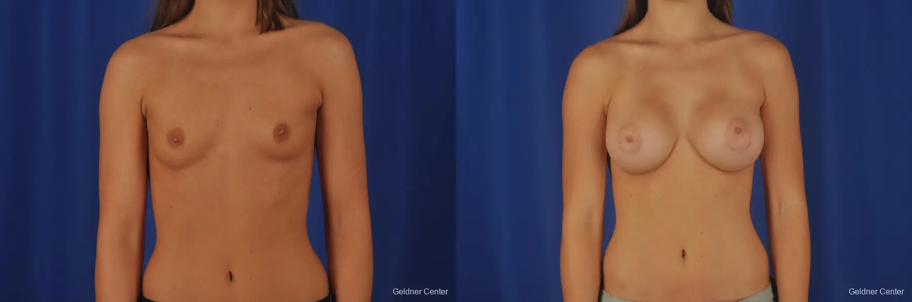 Breast Augmentation Streeterville, Chicago 3231 - Before and After 1