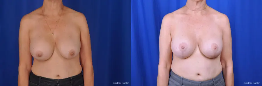 Breast Augmentation Lake Shore Dr, Chicago 2057 - Before and After 1