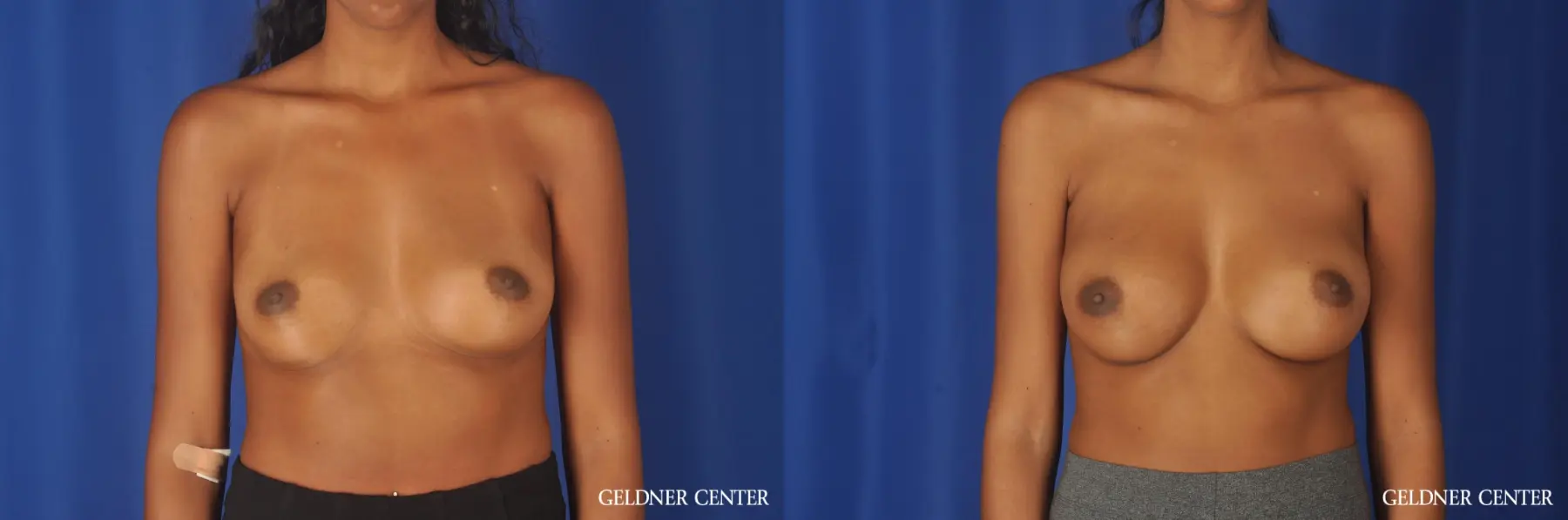 Chicago Breast Augmentation 11869 - Before and After