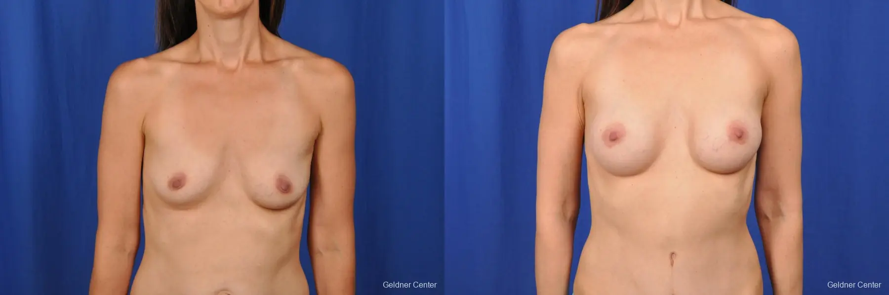 Chicago Breast Augmentation 2376 - Before and After 1