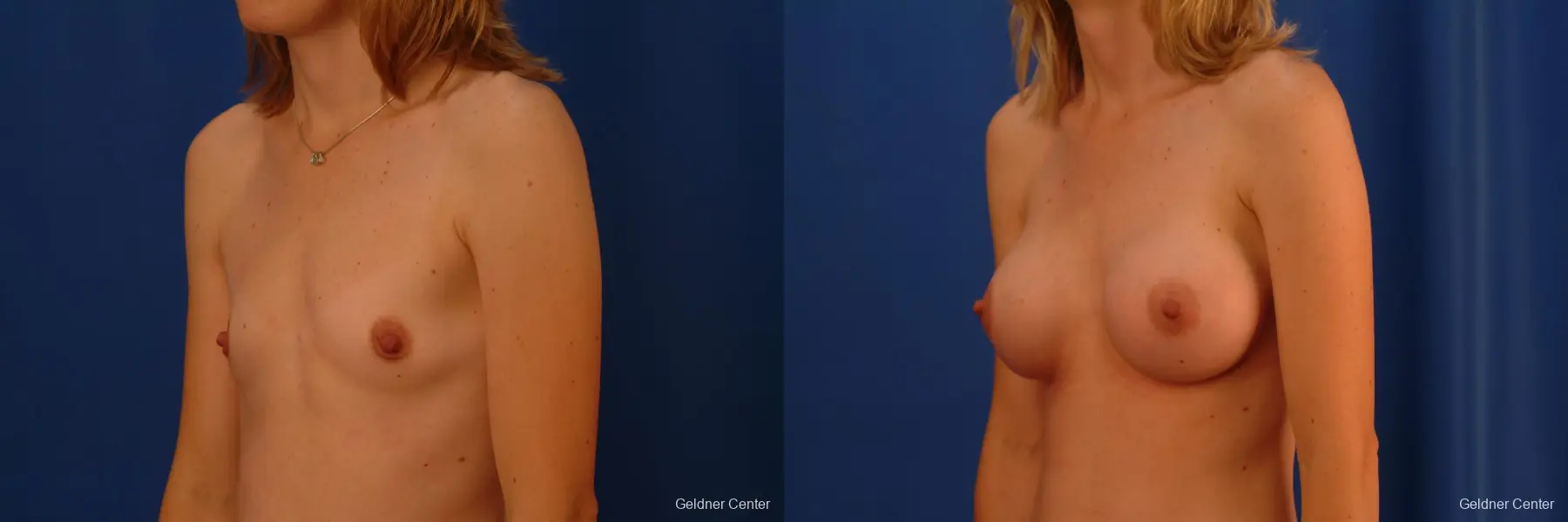 Breast Augmentation Streeterville, Chicago 2530 - Before and After 4
