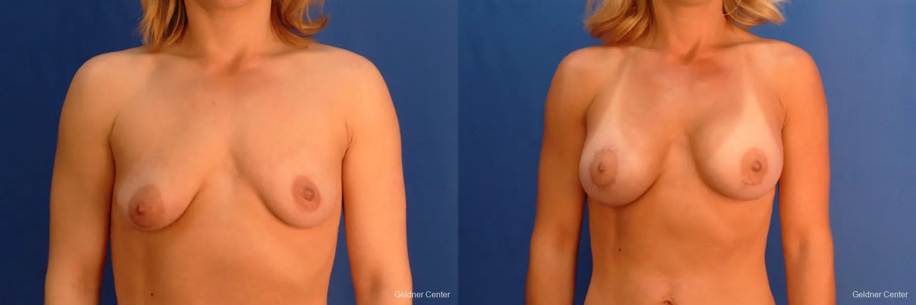 Breast Augmentation Lake Shore Dr, Chicago 2637 - Before and After 1