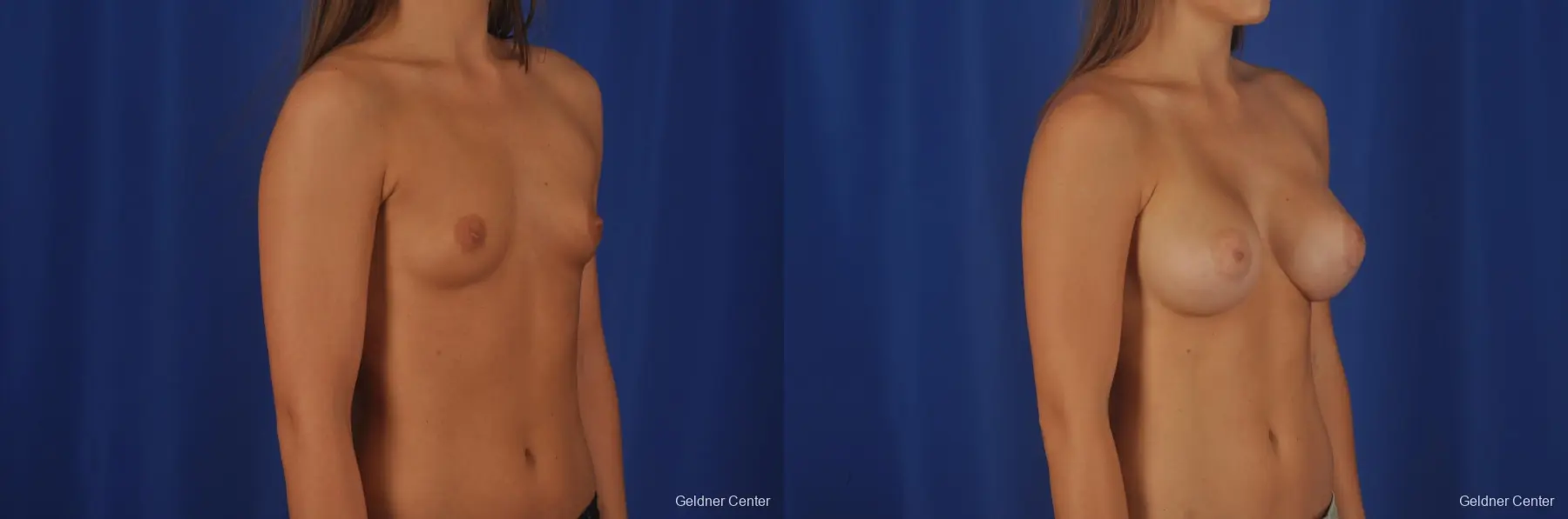 Breast Augmentation Streeterville, Chicago 3231 - Before and After 3