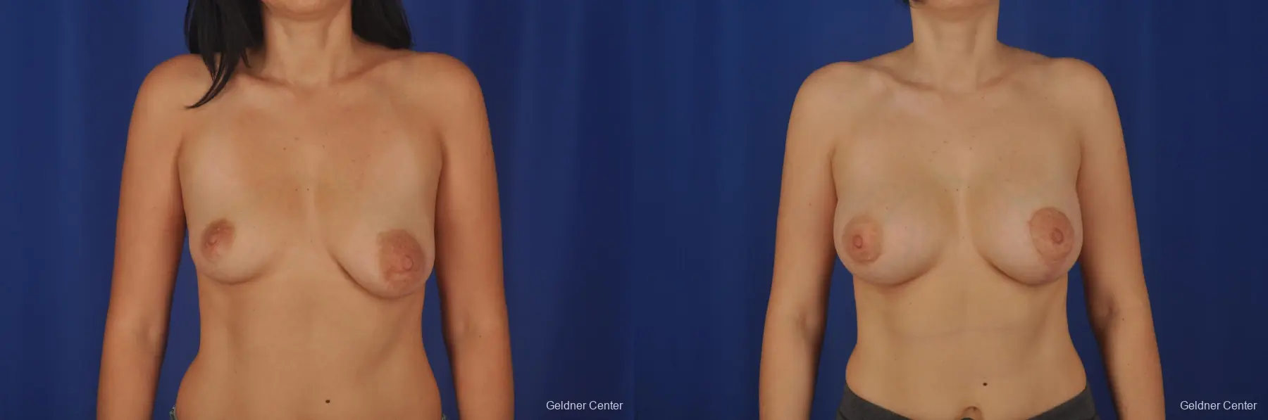 Chicago Breast Augmentation 2305 - Before and After 1