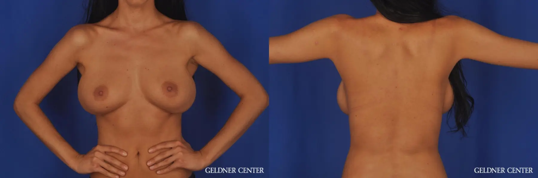 Breast Augmentation: Patient 163 - Before and After 5