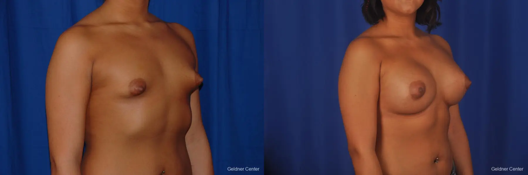 Breast Augmentation: Patient 157 - Before and After 2