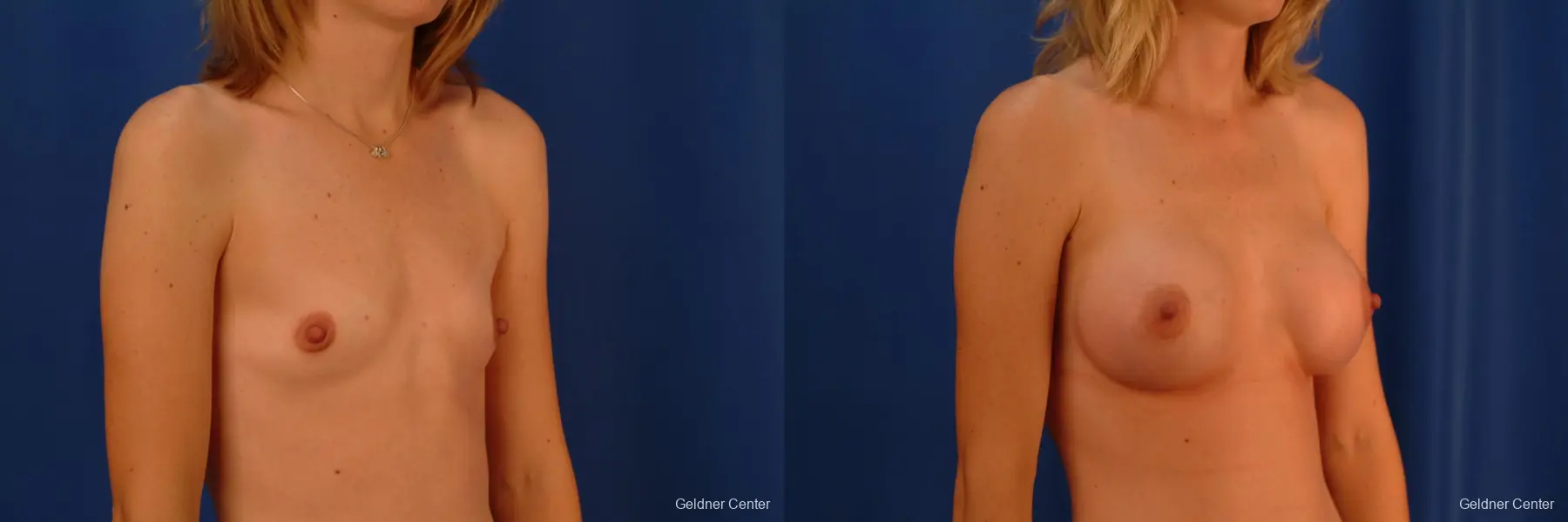 Breast Augmentation Streeterville, Chicago 2530 - Before and After 2