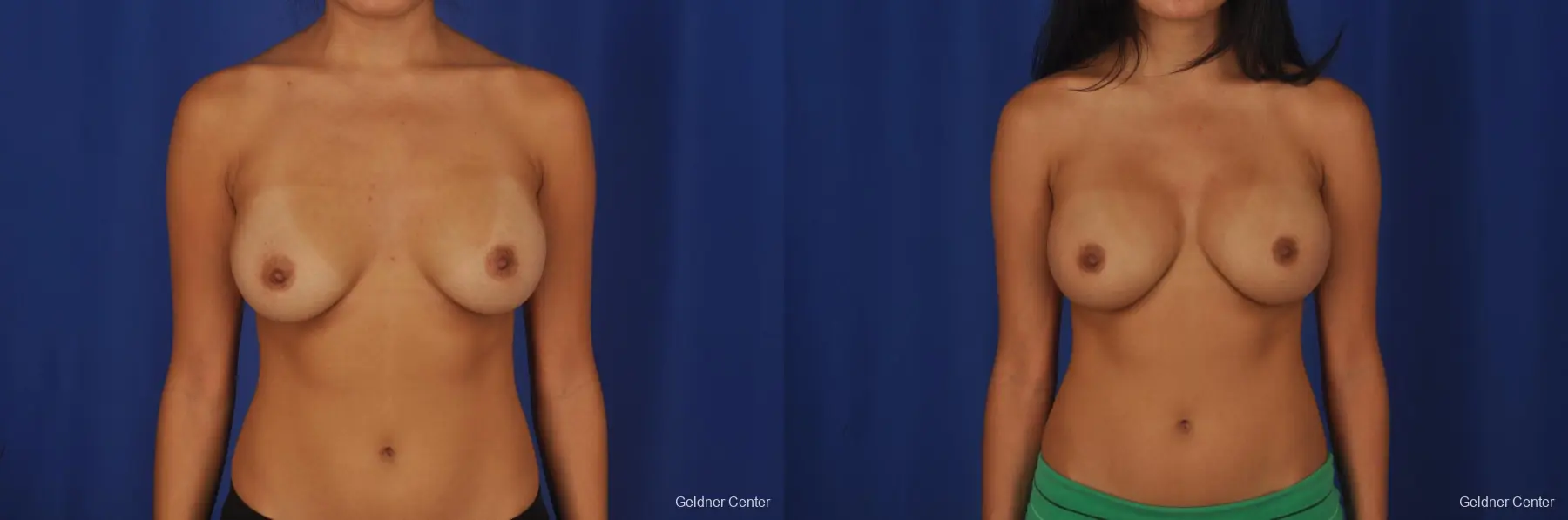 Breast Augmentation Streeterville, Chicago 2298 - Before and After 1