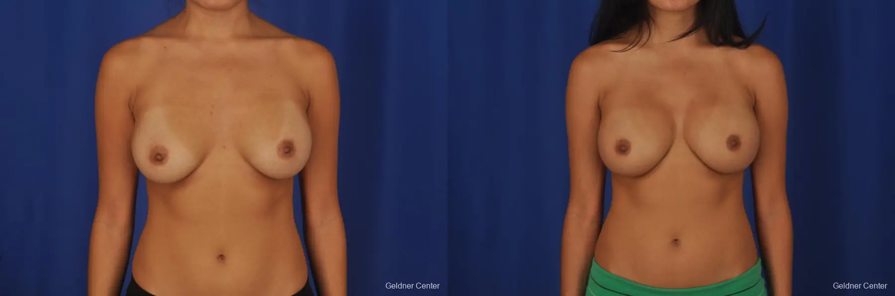 Breast Augmentation Streeterville, Chicago 2298 - Before and After