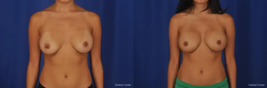 Breast Augmentation Streeterville, Chicago 2298 - Before and After 1