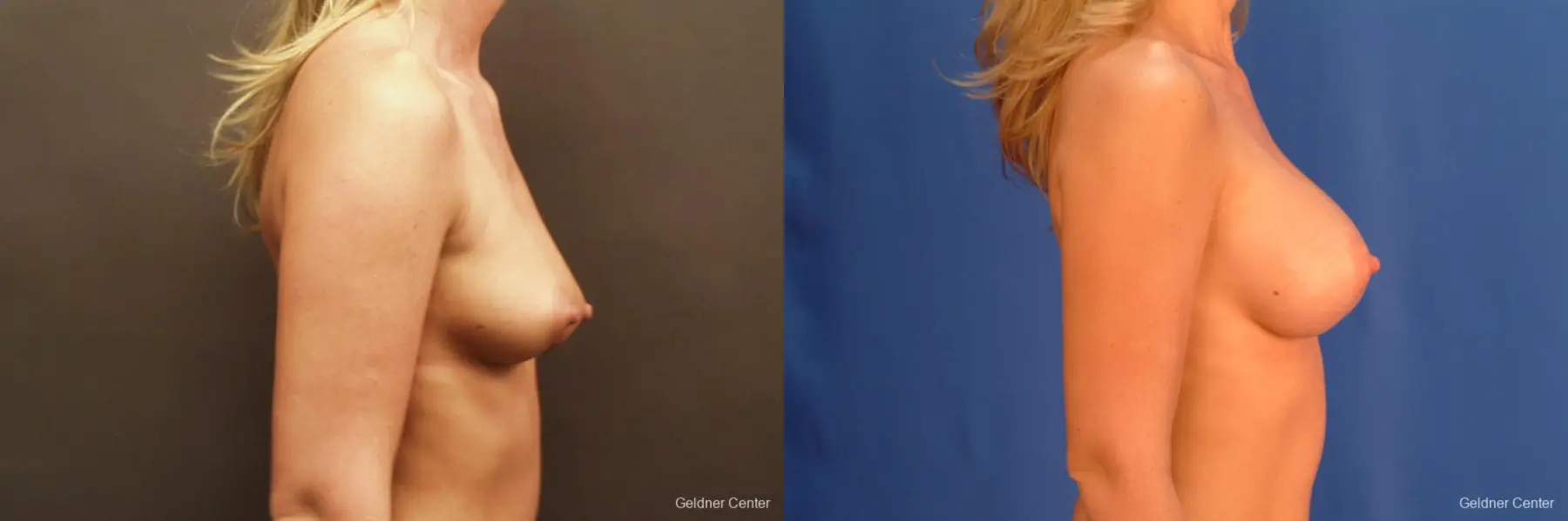 Breast Augmentation Streeterville, Chicago 2425 - Before and After 2