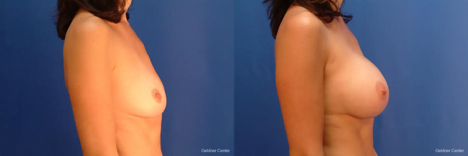 Breast Augmentation Streeterville, Chicago 2437 - Before and After 2
