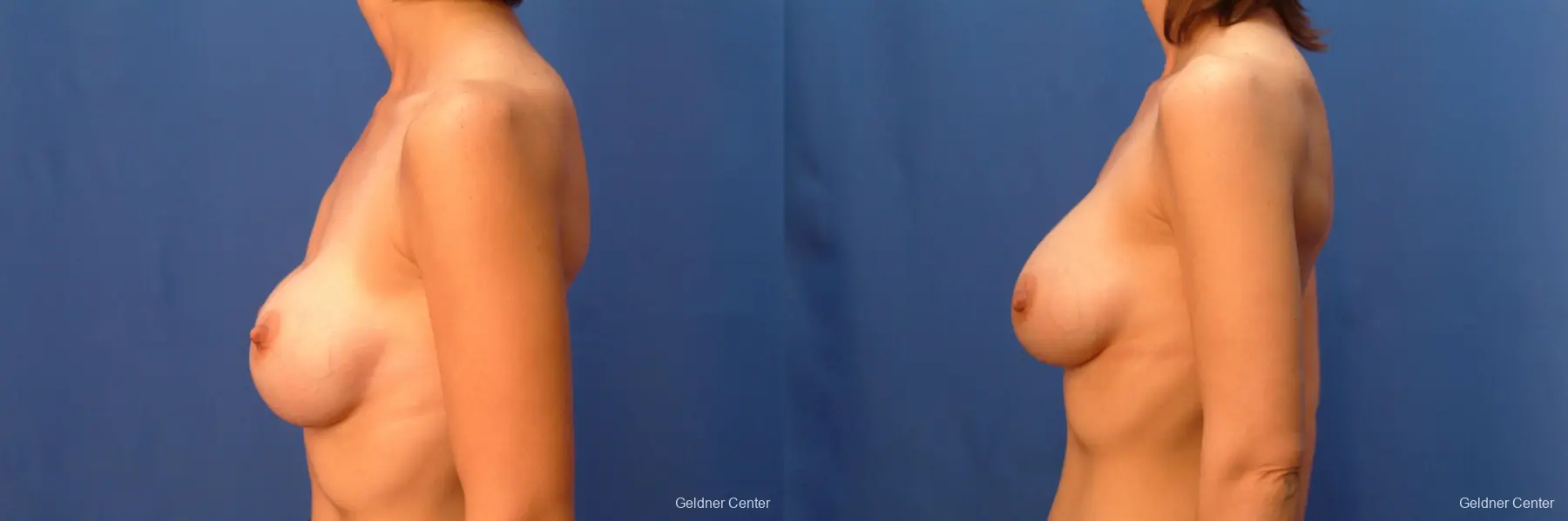 Chicago Breast Augmentation 2414 - Before and After 3