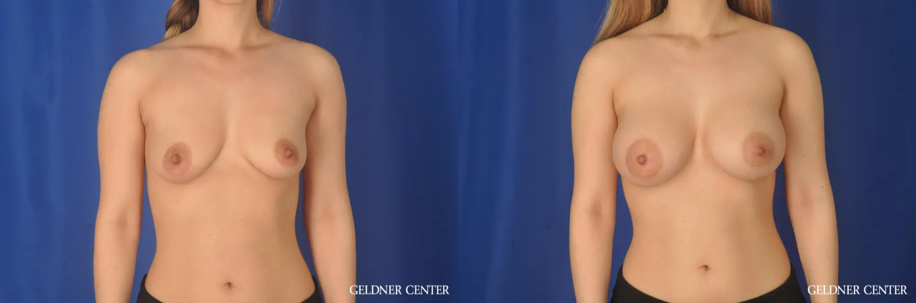 Breast Augmentation Lake Shore Dr, Chicago 11849 - Before and After