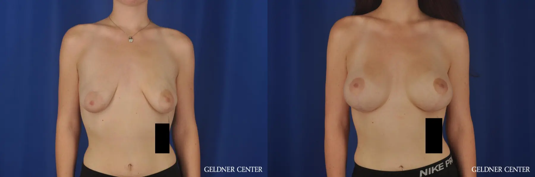 Breast Augmentation Streeterville, Chicago 5547 - Before and After