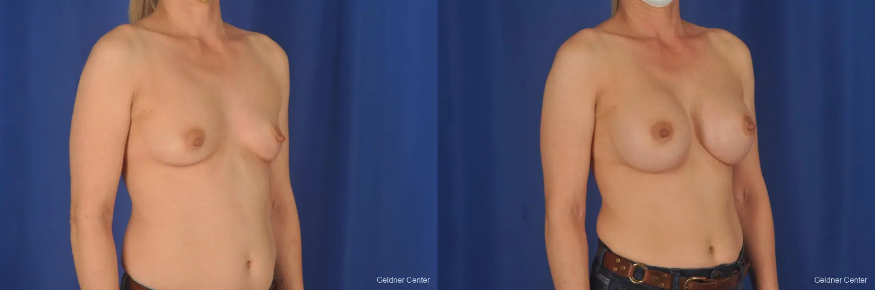 Breast Augmentation: Patient 188 - Before and After 3