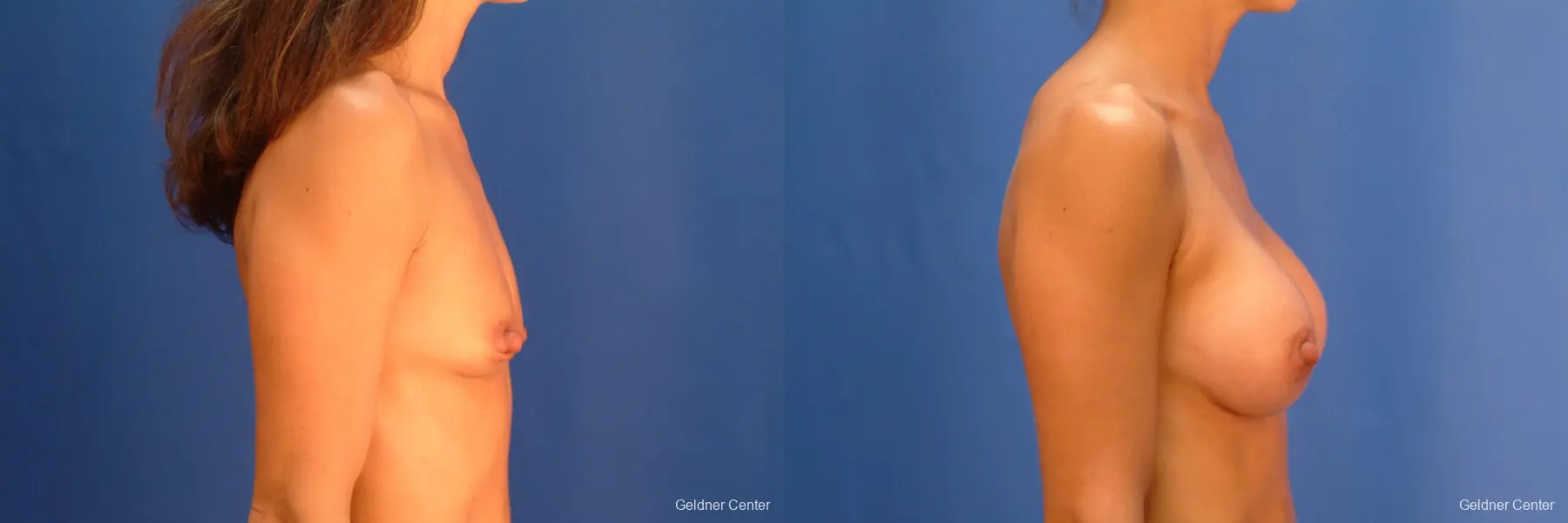 Chicago Breast Augmentation 2521 - Before and After 2