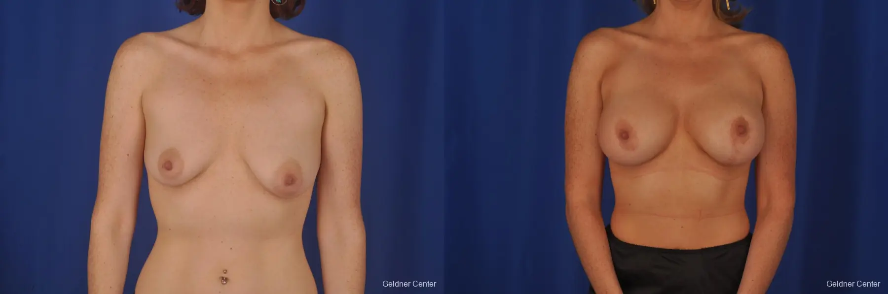 Chicago Breast Augmentation 2399 - Before and After