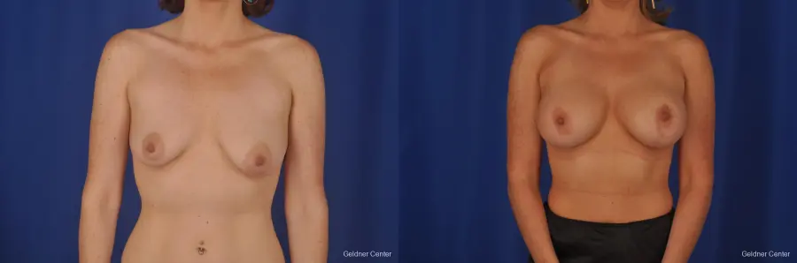 Chicago Breast Augmentation 2399 - Before and After 1