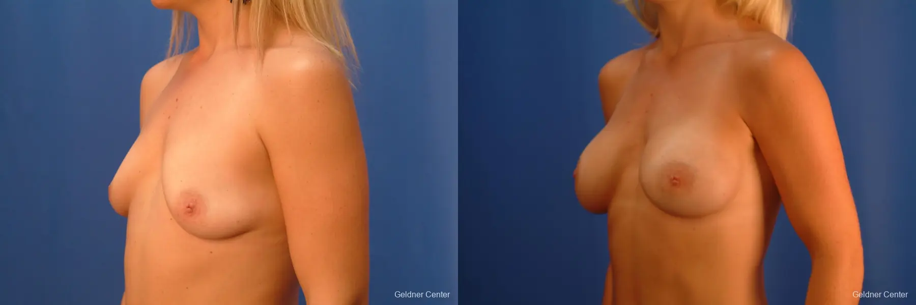 Breast Augmentation Lake Shore Dr, Chicago 2350 - Before and After 4