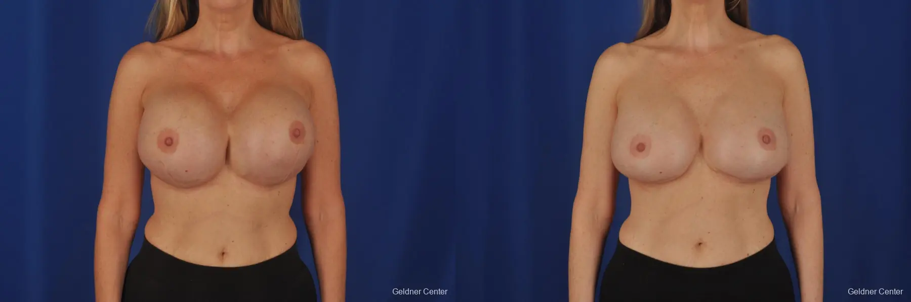 Breast Augmentation Streeterville, Chicago 2388 - Before and After