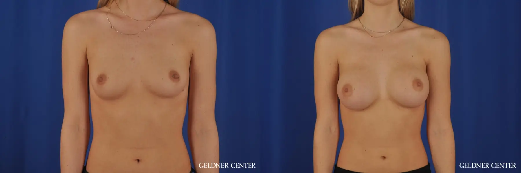 Breast Augmentation Streeterville, Chicago 4294 - Before and After