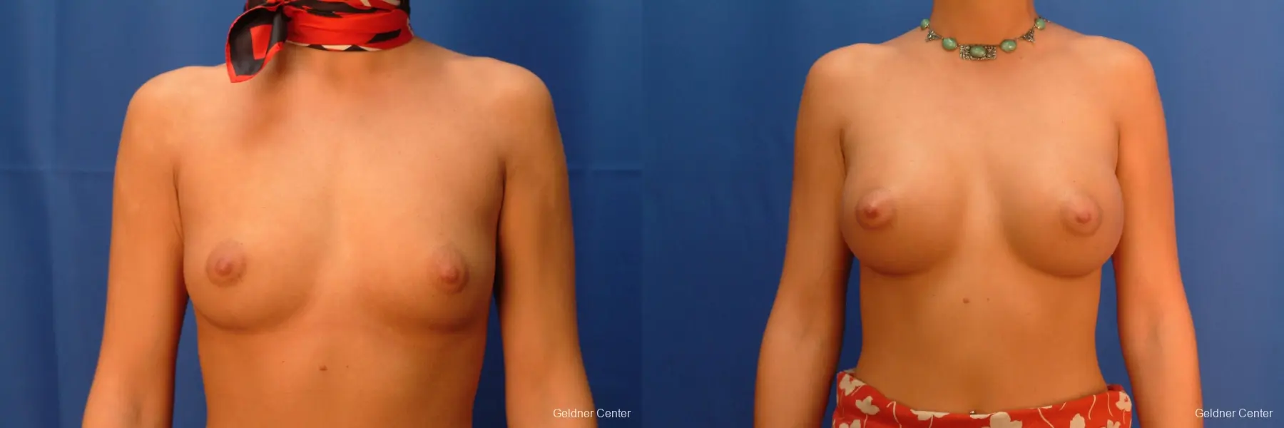 Breast Augmentation Hinsdale, Chicago 2438 - Before and After 1