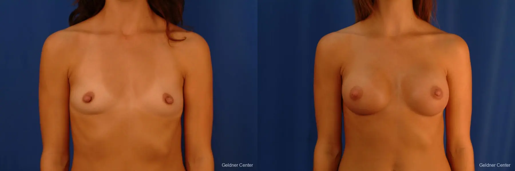 Breast Augmentation Hinsdale, Chicago 2412 - Before and After 1