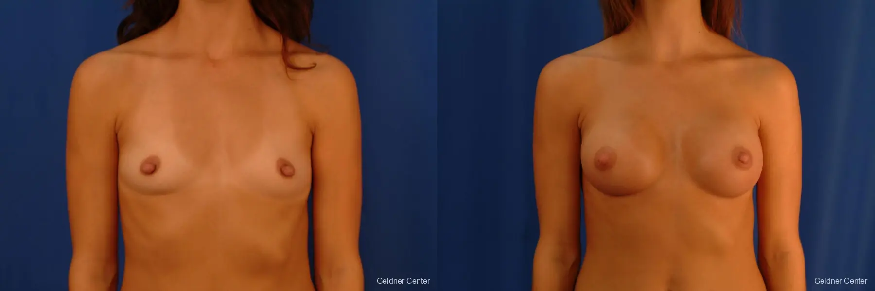 Breast Augmentation Hinsdale, Chicago 2412 - Before and After