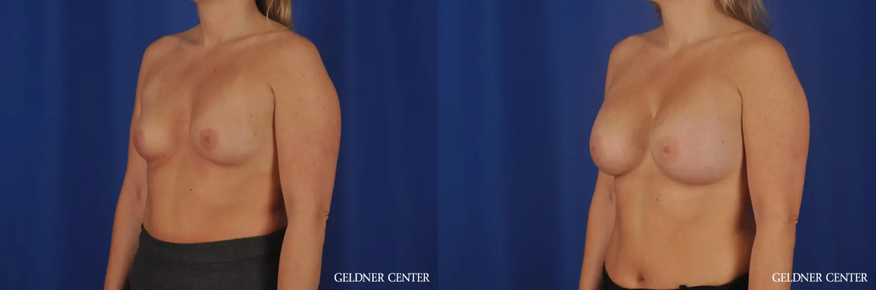 Breast Augmentation: Patient 185 - Before and After 4