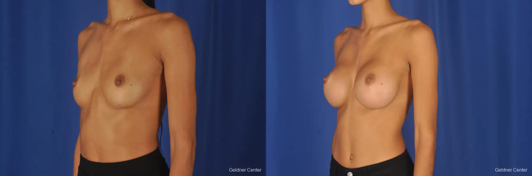 Breast Augmentation: Patient 85 - Before and After 4