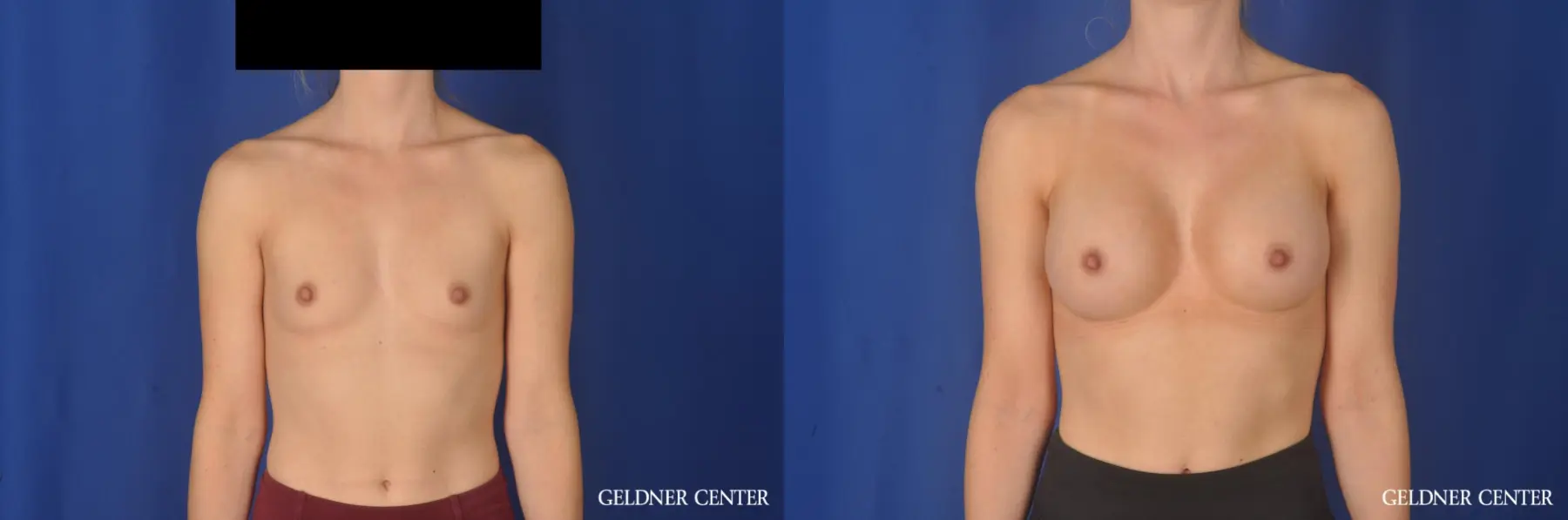 Breast Augmentation: Patient 187 - Before and After 1