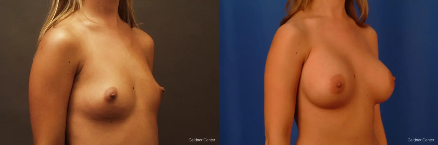 Breast Augmentation Lake Shore Dr, Chicago 2533 - Before and After 3