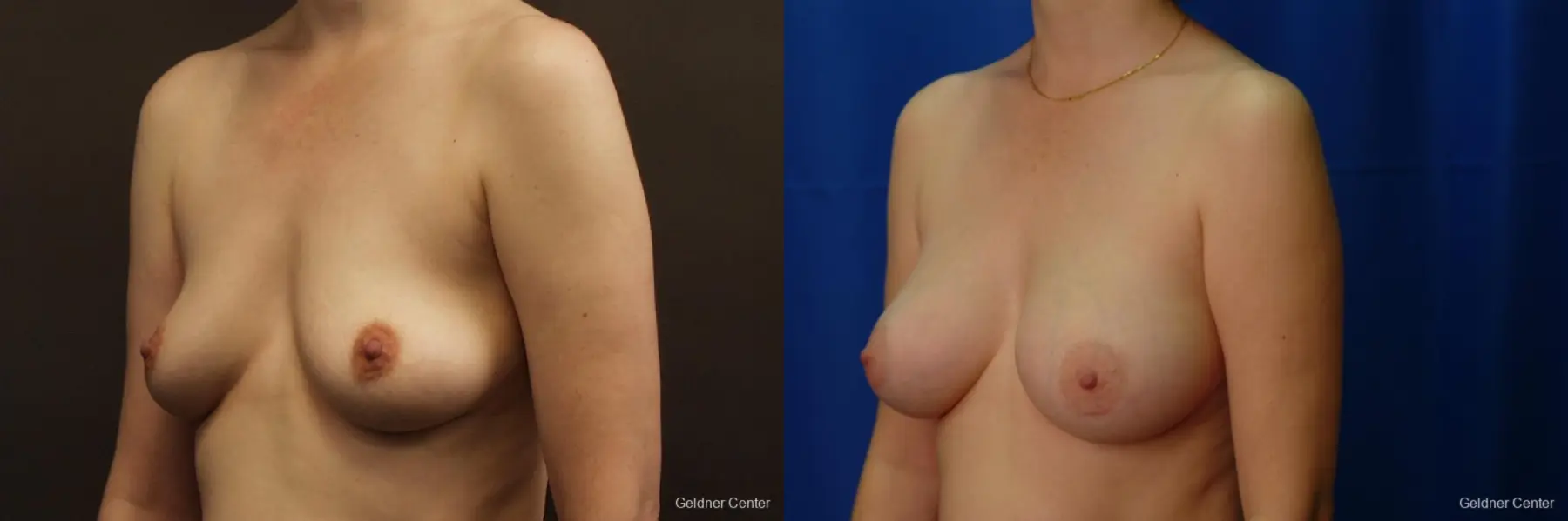 Chicago Breast Augmentation 2413 - Before and After 4