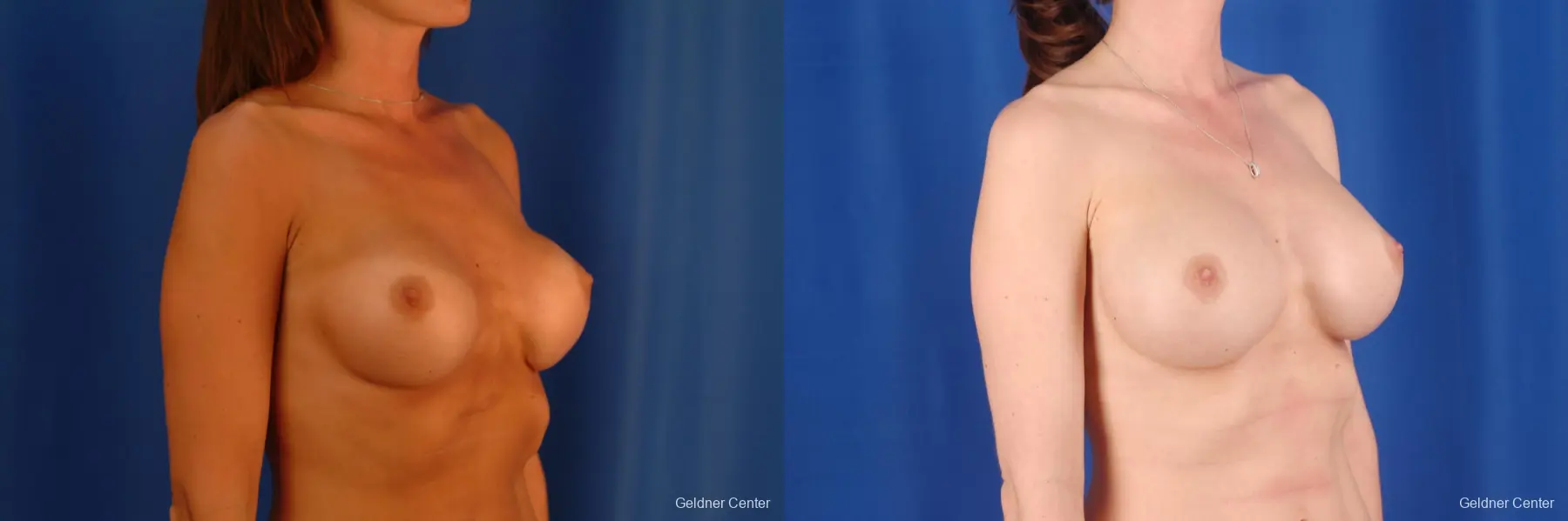 Breast Augmentation Lake Shore Dr, Chicago 2619 - Before and After 3