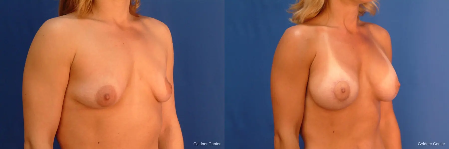 Breast Augmentation Lake Shore Dr, Chicago 2637 - Before and After 3