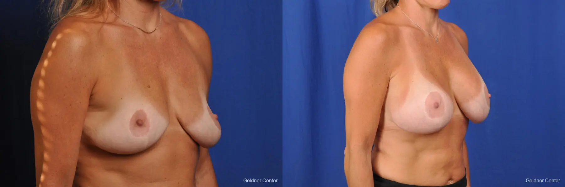 Breast Augmentation Hinsdale, Chicago 2391 - Before and After 3