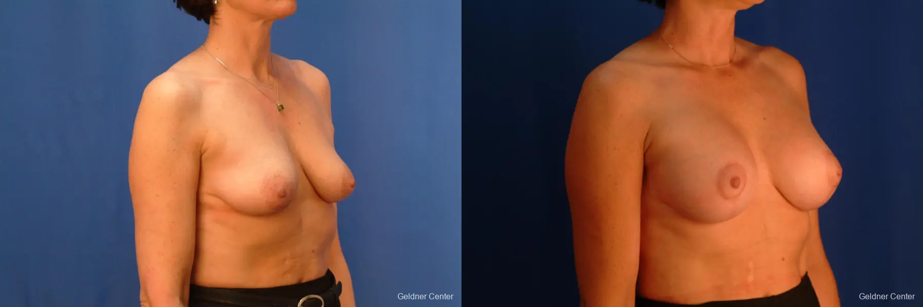 Breast Augmentation Streeterville, Chicago 2508 - Before and After 3