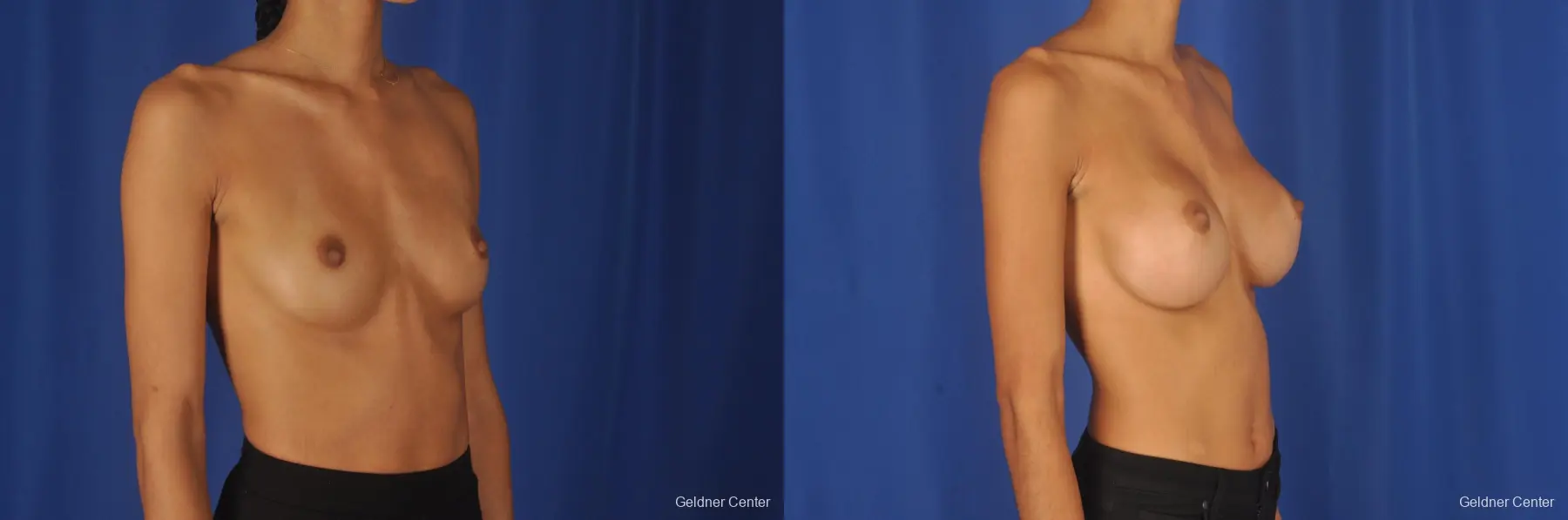 Breast Augmentation: Patient 85 - Before and After 3