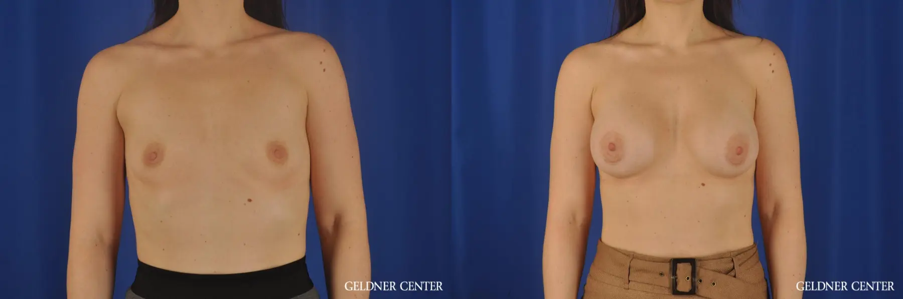 Chicago Breast Augmentation 8760 - Before and After