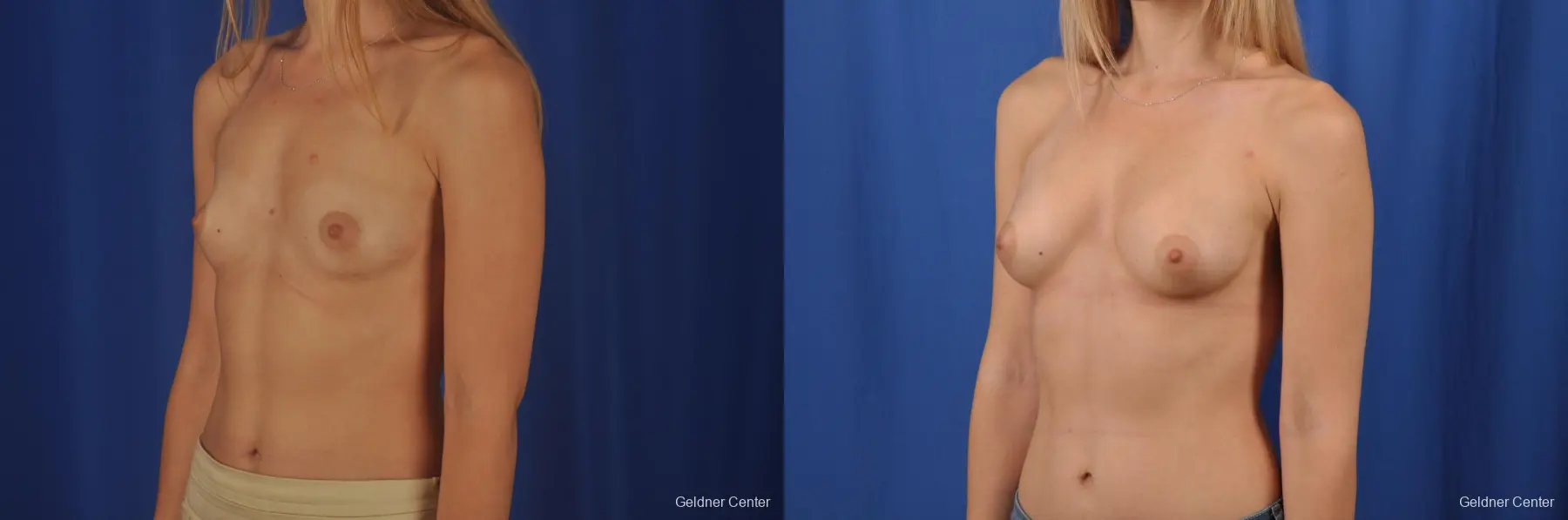 Breast Augmentation: Patient 150 - Before and After 4