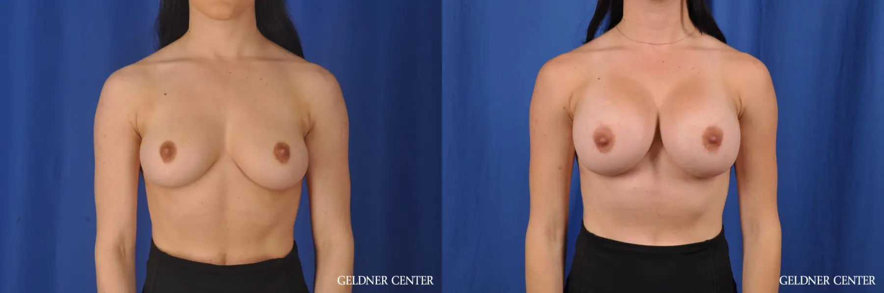 Biplanar Subpectoral 350cc - Before and After