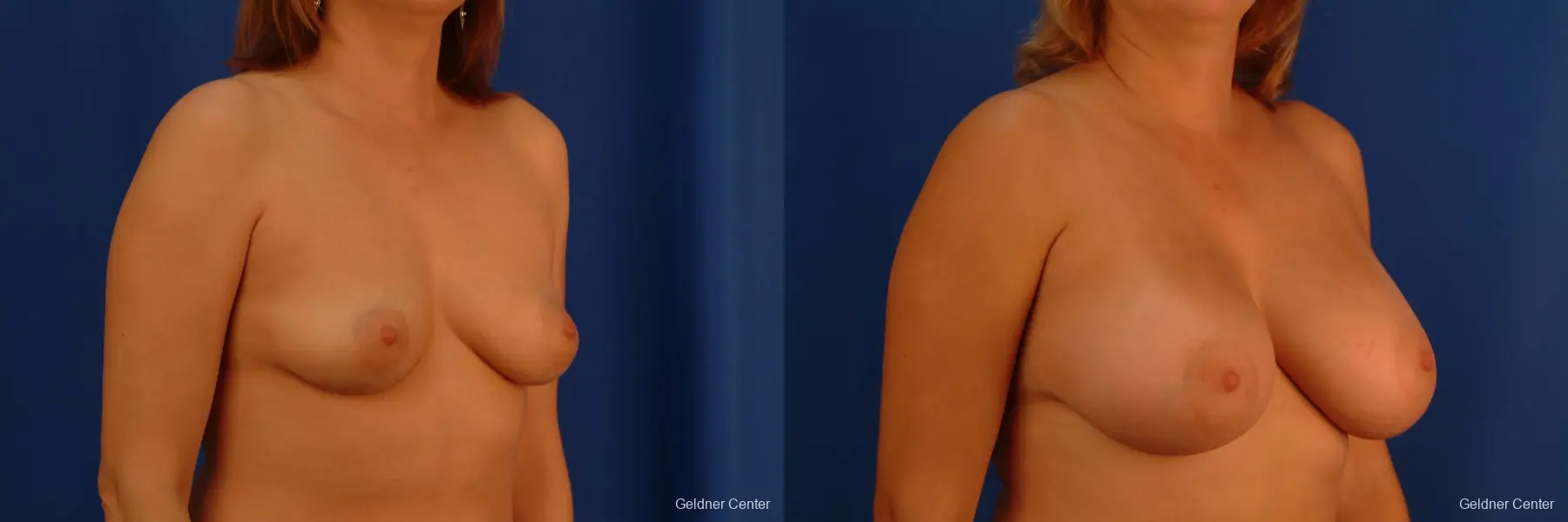 Chicago Breast Augmentation 2532 - Before and After 3