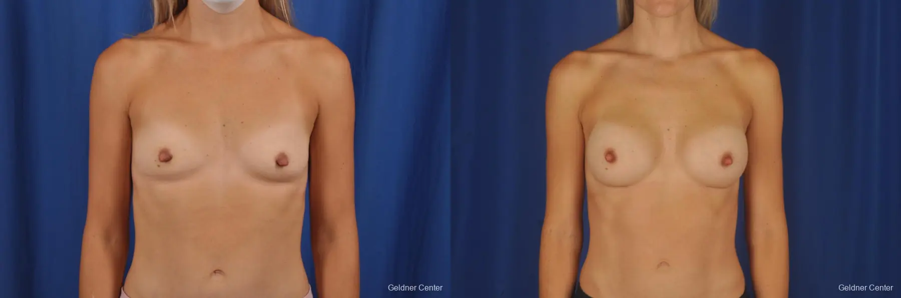 Breast Augmentation: Patient 189 - Before and After 1