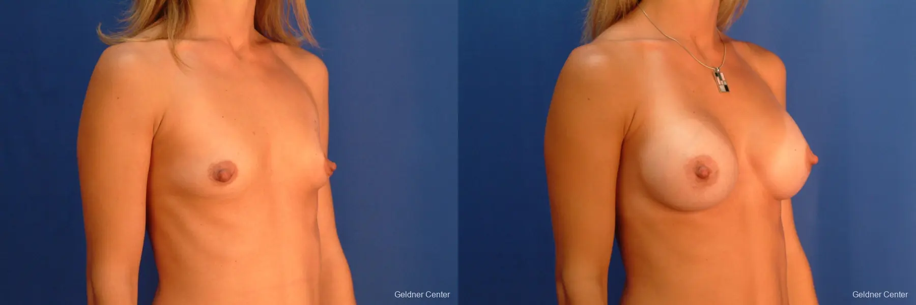 Breast Augmentation Hinsdale, Chicago 2510 - Before and After 3