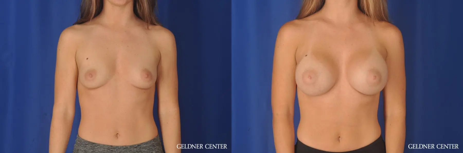 Biplanar Subpectoral 350cc - Before and After