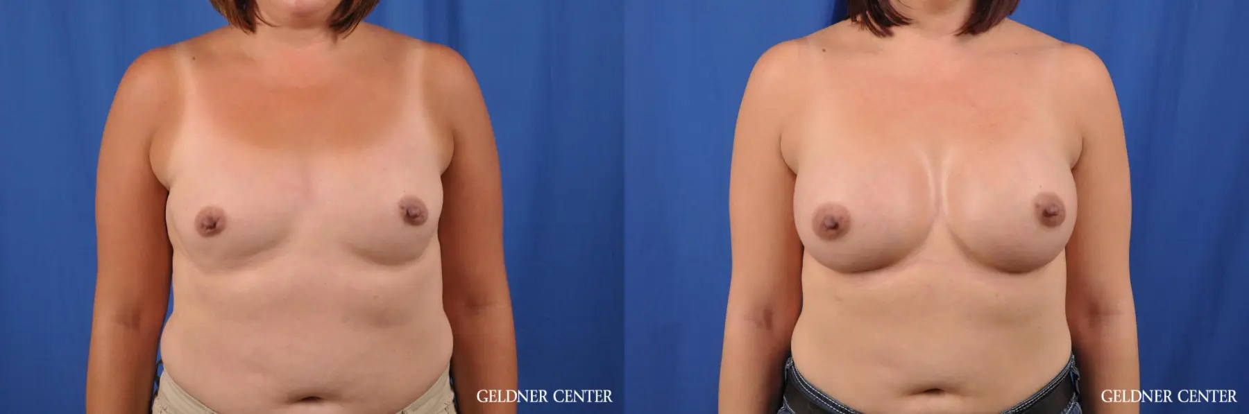 Biplanar Subpectoral 400cc - Before and After