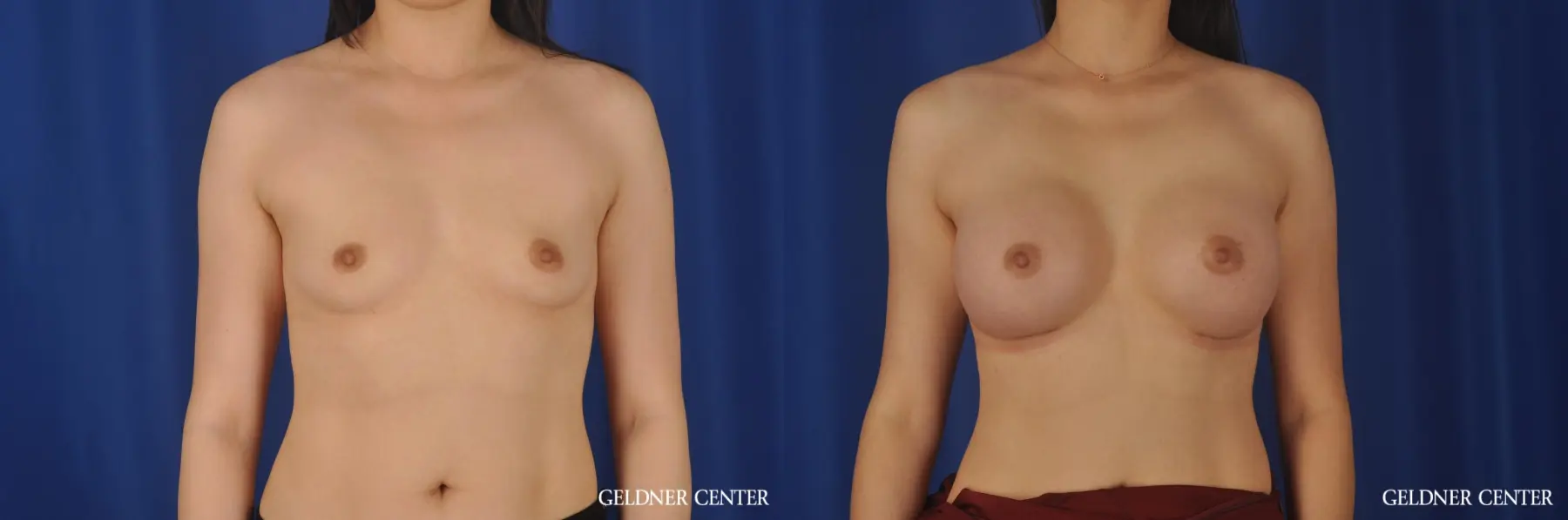 Breast Augmentation Hinsdale, Chicago 8751 - Before and After