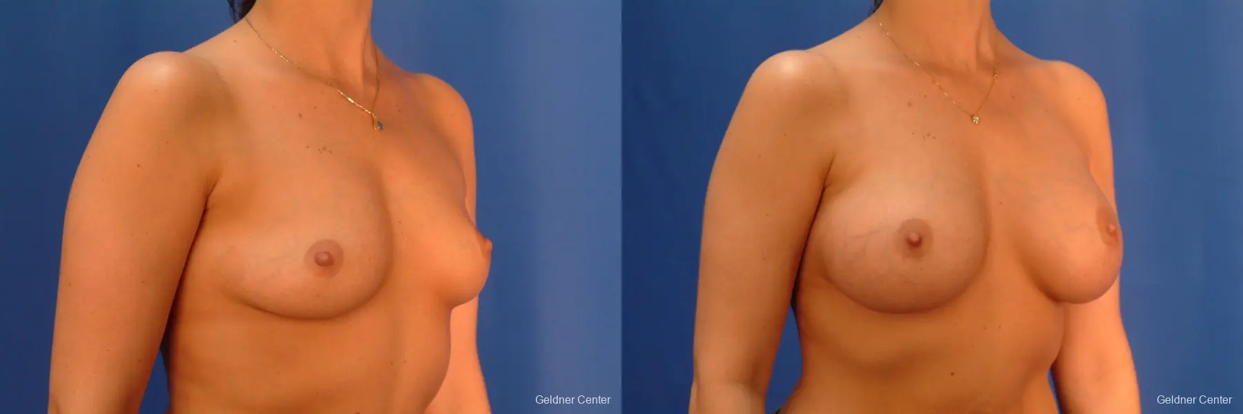 Chicago Breast Augmentation 2432 - Before and After 3
